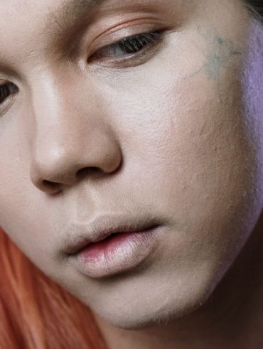 Drugstore Hormonal Chin Acne Treatment: The  Drugstore Protocol That Stopped My Hormonal Chin Acne