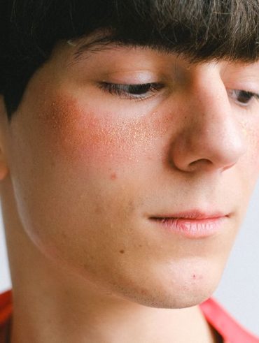 Hormonal Acne On Chin Treatment: Chin Acne Treatment: The Step-by-Step Fix for Hormonal Breakouts