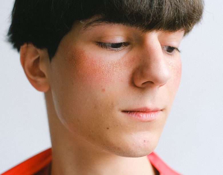 Hormonal Acne On Chin Treatment: Chin Acne Treatment: The Step-by-Step Fix for Hormonal Breakouts Hormonal Acne On Chin Treatment: Chin Acne Treatment: The Step-by-Step Fix for Hormonal Breakouts