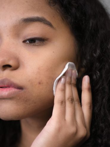 How I Finally Got Rid of Hormonal Chin Acne Without Prescription Meds How I Finally Got Rid of Hormonal Chin Acne Without Prescription Meds