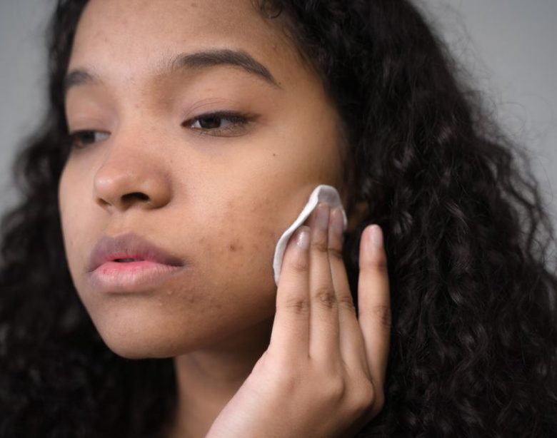 How I Finally Got Rid of Hormonal Chin Acne Without Prescription Meds