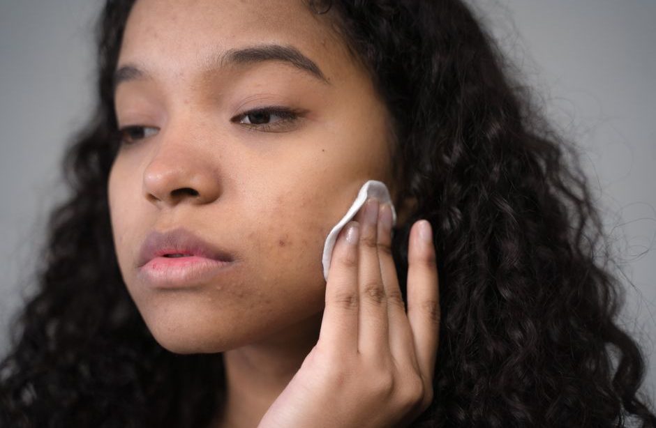 How I Finally Got Rid of Hormonal Chin Acne Without Prescription Meds